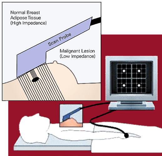 A medical illustration showing a breast cancer detection procedure using electrical impedance scanning. A patient is lying down while a scan probe is placed on the breast. An inset diagram highlights how the probe detects differences in impedance between normal breast adipose tissue (high impedance) and malignant lesions (low impedance). The probe is connected to a computer displaying a grid with white dots, likely representing detected areas of concern.